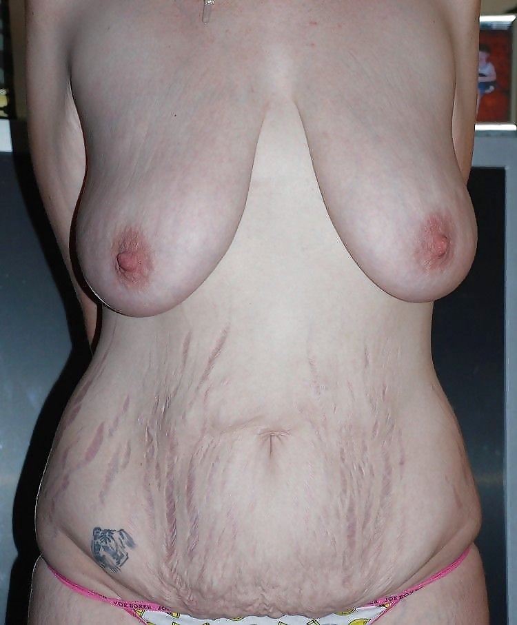 Ugly Fat Stretch Marks Cellulite Pregnant Naked