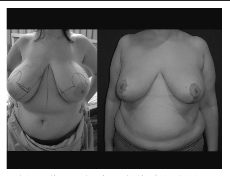 Mironenko Yana Macromastia xxx