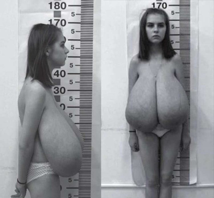 Gigantomastia of megalomastia