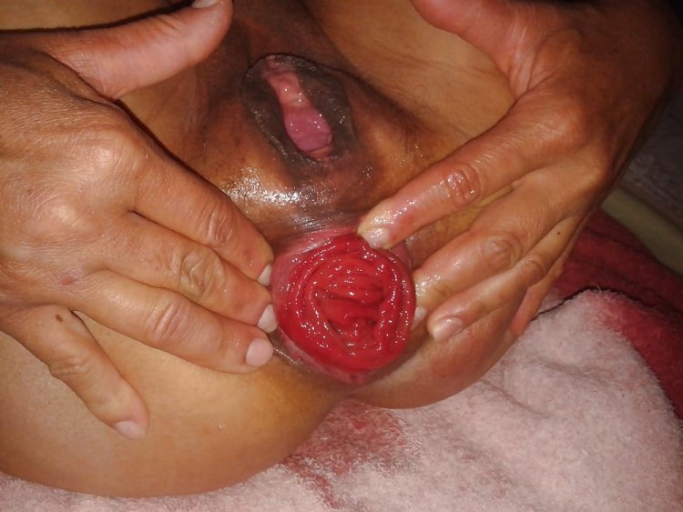 Di Williams anal in prolapse