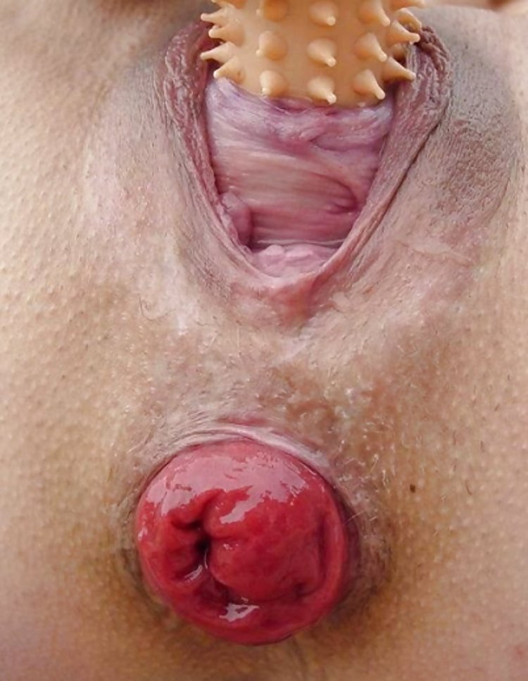 Wide female urethra