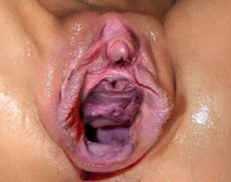 A large gap of the vagina