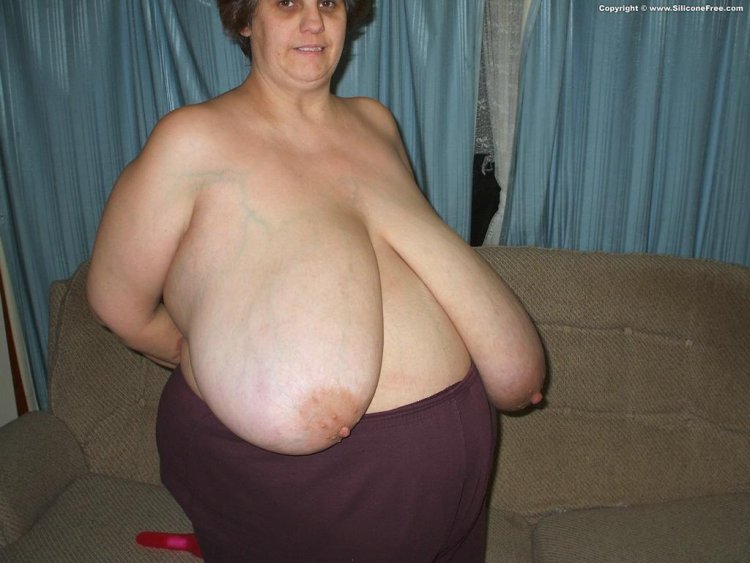 Macromastia of Grenny gigantomastia