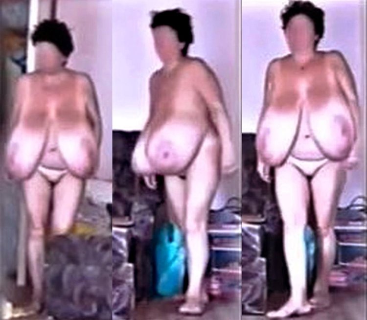 Macromastia of Grenny gigantomastia