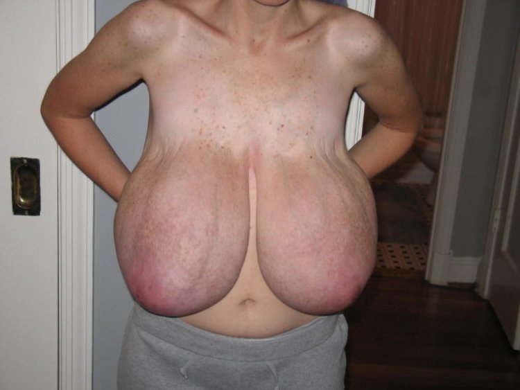 Macromastia of Grenny gigantomastia