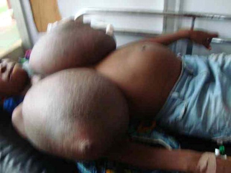 Huge boobs of macromastia