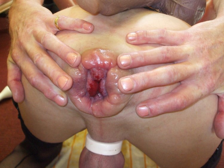 Anal Pumping Loose Asshole Huge Mancunt Lips