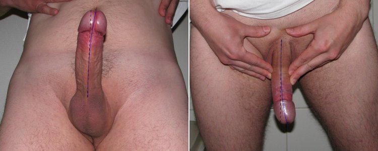 Curvating a penis to the side