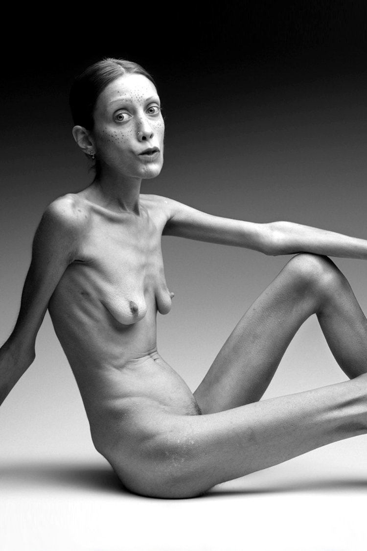 Isabelle Caro Anorexia