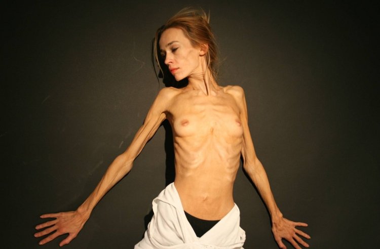 Anorexic nude girls