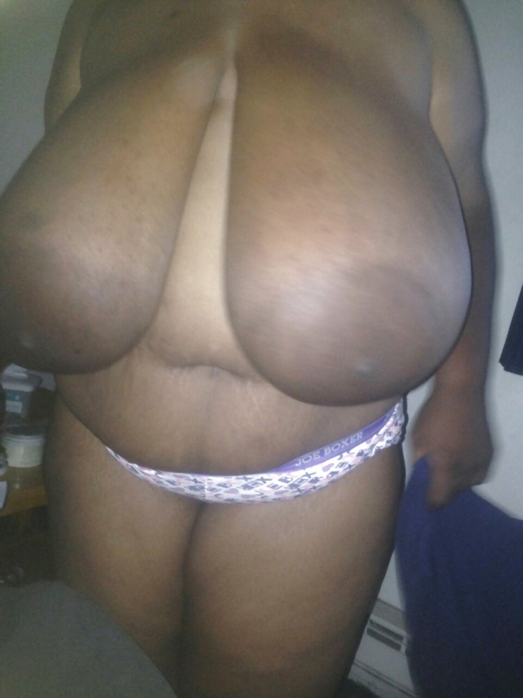 Macromastia of gigantomastia