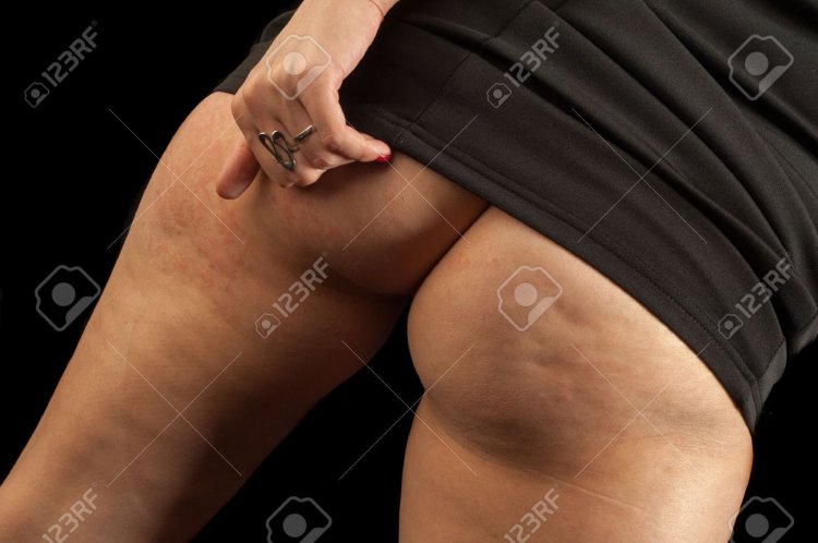 Naked thick cellulite women