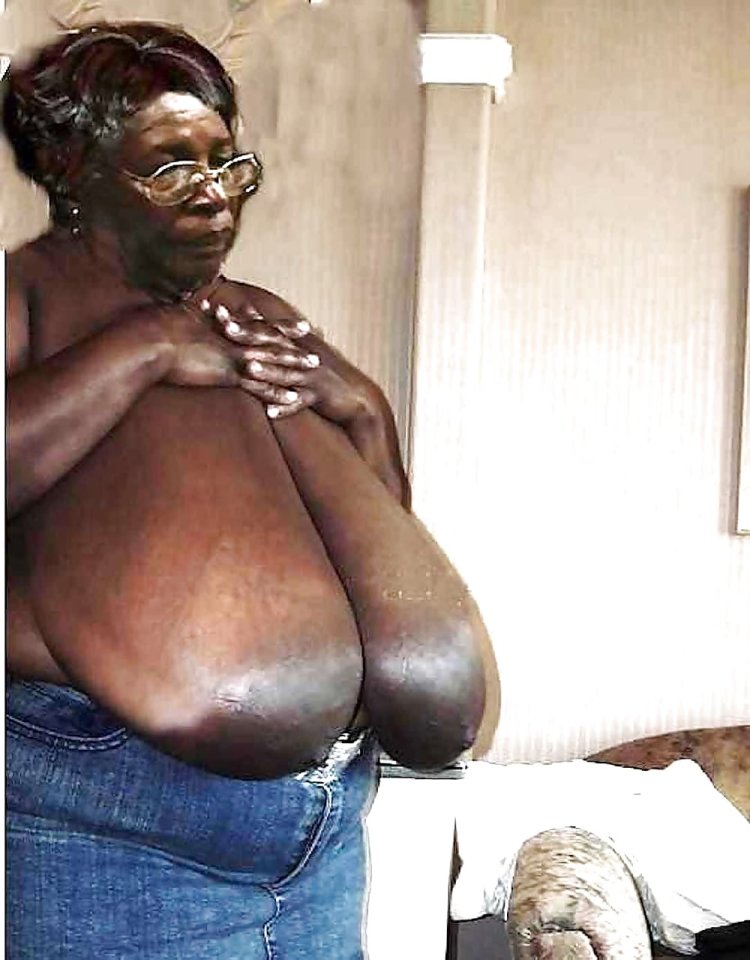 Macromastia of Grenny gigantomastia