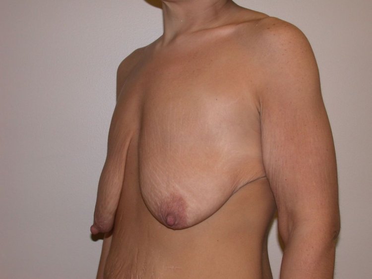 Hanging breasts with wrinkles