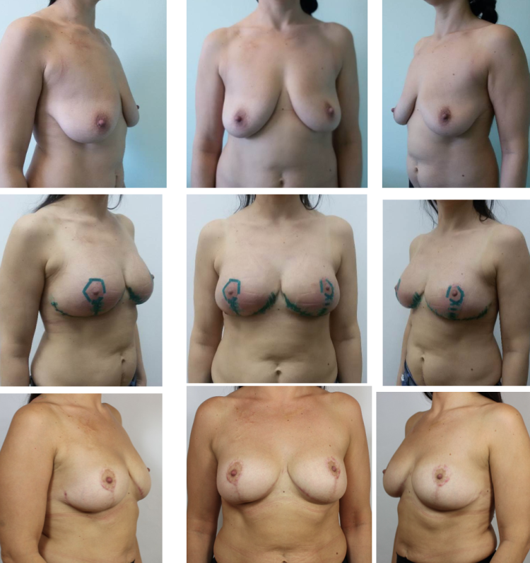 Forms of naked female breast