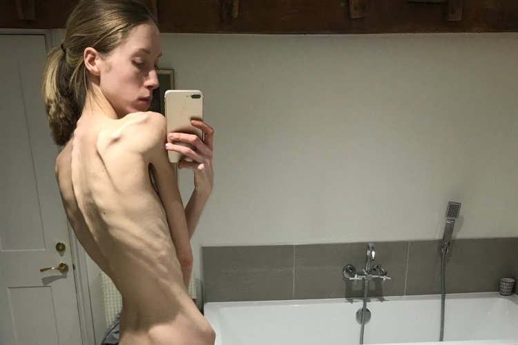 Anorexics swim naked
