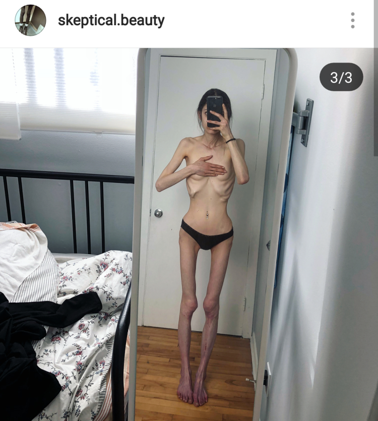 Anorexic teenager nude