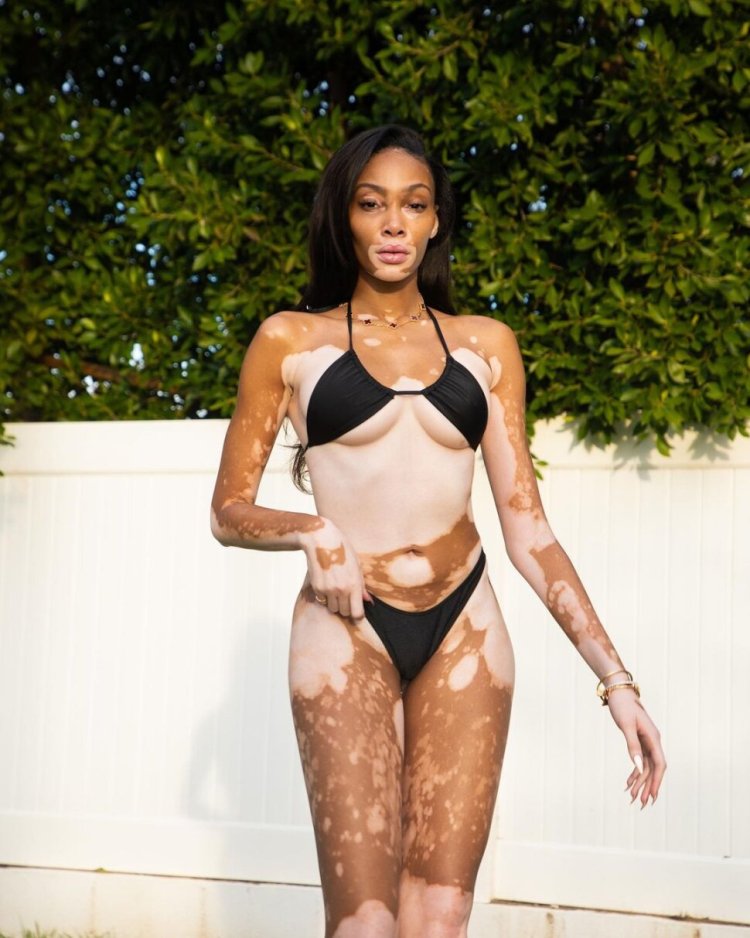 Canadian fashion model Winnie Harlow