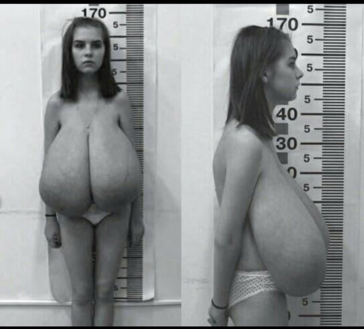 Macromastia of gigantomastia in women nude